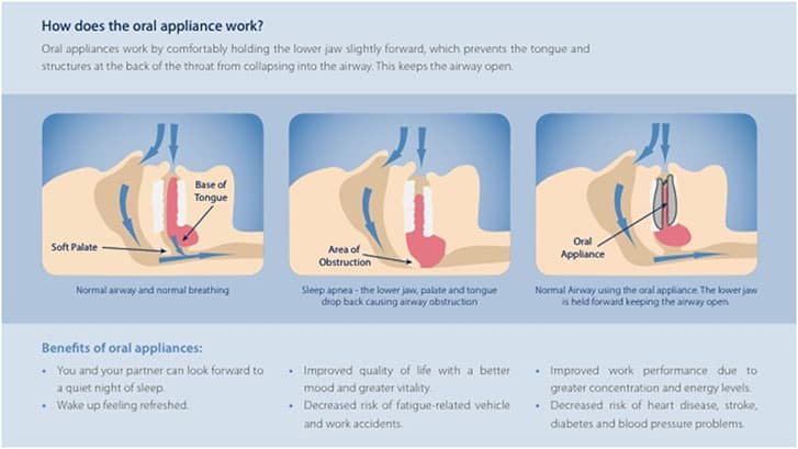 how-oral-appliance-work